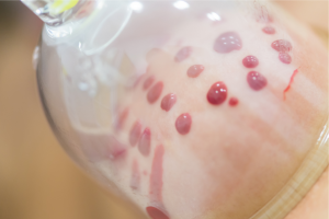 hijama humide wet cupping