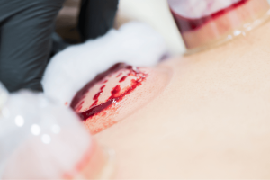 formation cupping thérapie